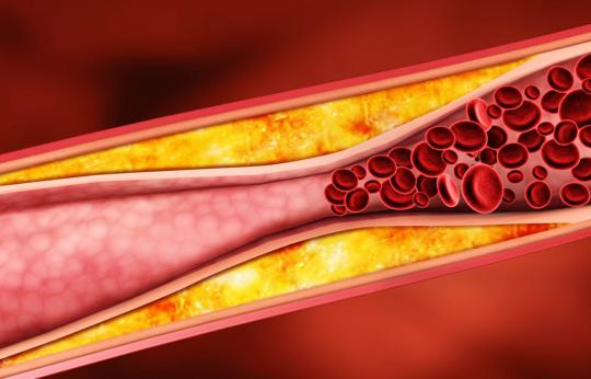 Interpretación del LDL colesterol en tu perfil lipídico: comprende su impacto en tu salud cardiovascular
